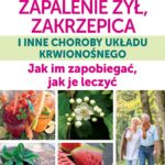 Poradnik na temat leczenia żylaków